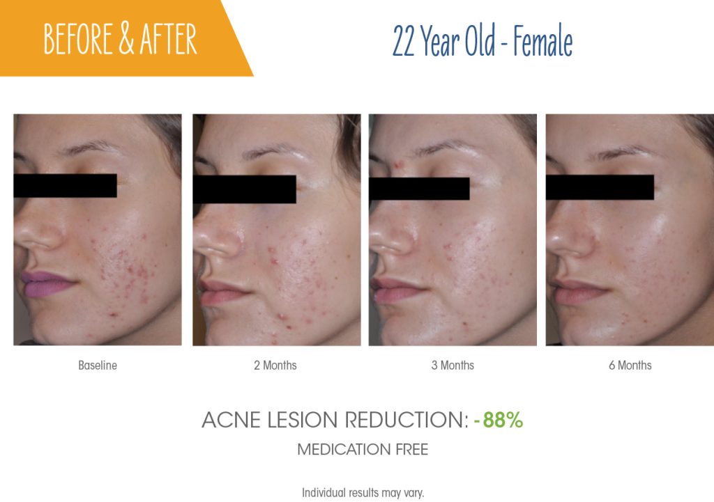 sebacia-before-after
