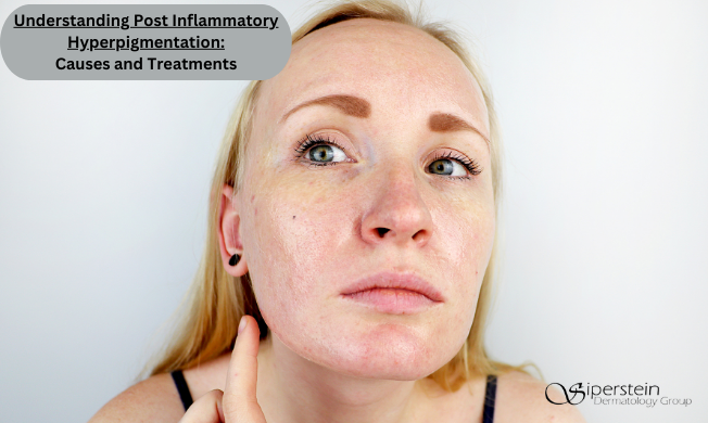 Understanding Post Inflammatory Hyperpigmentation